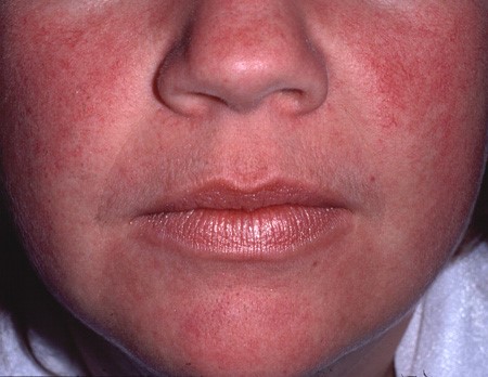Facial telangiectasia from over ten years daily application of fluocinolone acetonide. 