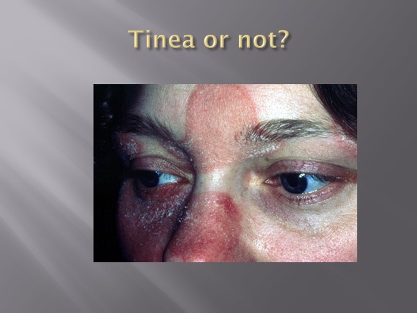 Tinea incognito of the face. Scaly edges are not seen in an eczematous rash.